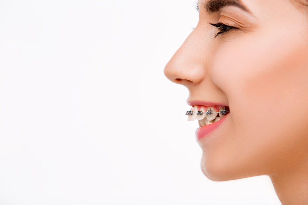 出っ歯をワイヤー矯正で治療する女性